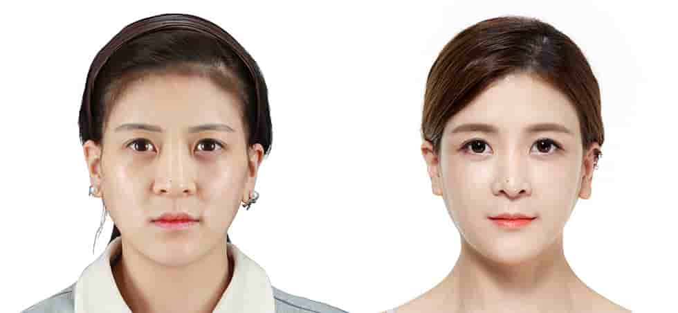 JK Plastic Surgery Clinic في Seoul، South Korea تعليقات من مرضى حقيقيين
 Slider image 2