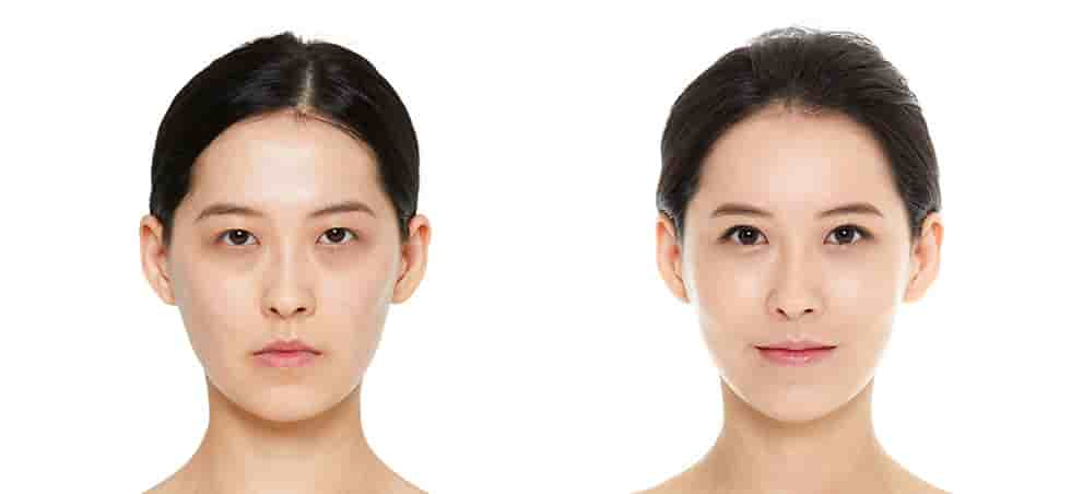 JK Plastic Surgery Clinic في Seoul، South Korea تعليقات من مرضى حقيقيين
 Slider image 3