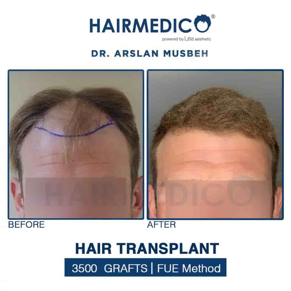 Hairmedico في Istanbul، Turkey تعليقات من مرضى حقيقيين
 Slider image 1