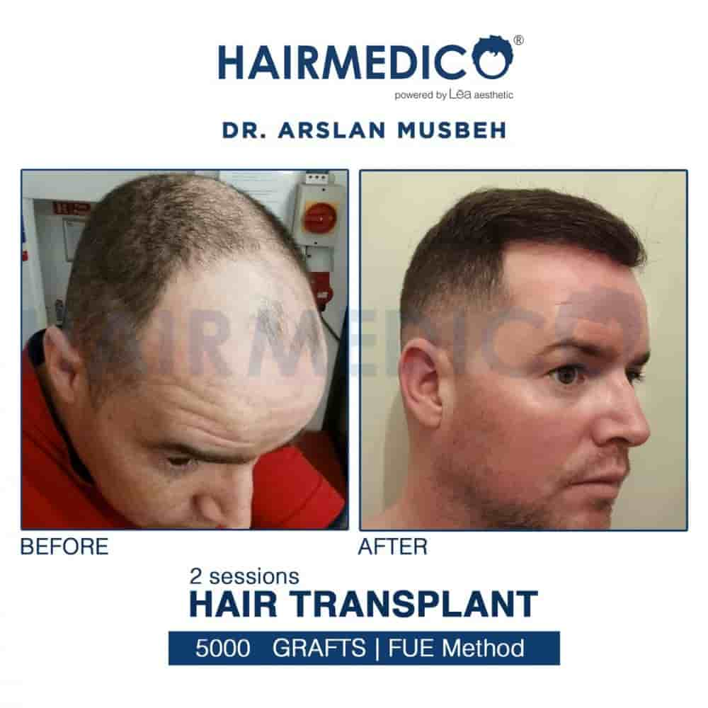 Hairmedico في Istanbul، Turkey تعليقات من مرضى حقيقيين
 Slider image 3