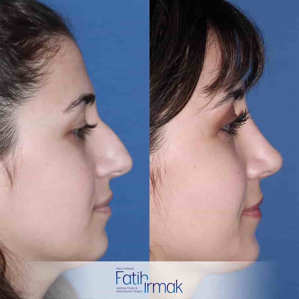 Assoc. Prof. Fatih Irmak Aesthetic and Plastic Surgery Clinic في Istanbul، Turkey تعليقات من مرضى حقيقيين
 Slider image 3