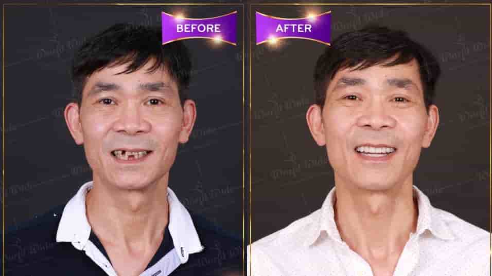 Worldwide Dental & Cosmetic Surgery Hospital في Ho Chi Minh، Vietnam تعليقات من مرضى حقيقيين
 Slider image 2