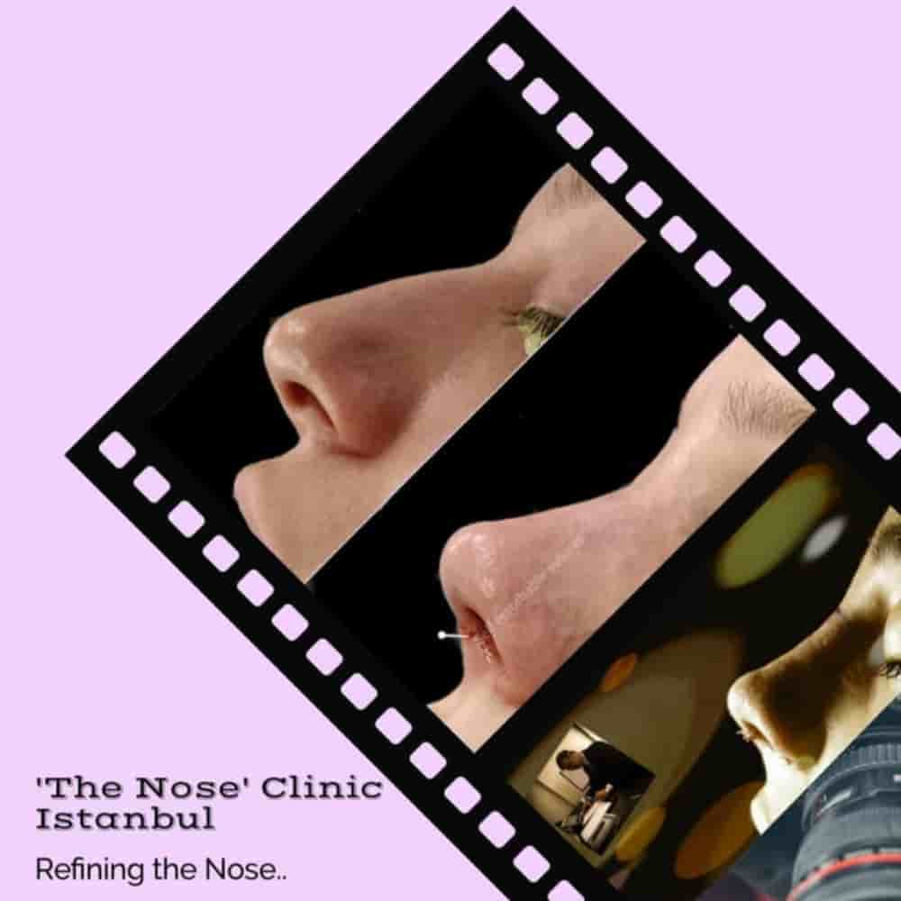 The Nose Aesthetic Clinic في Istanbul، Turkey تعليقات من مرضى حقيقيين
 Slider image 3