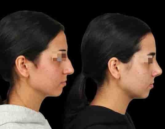 The Nose Aesthetic Clinic في Istanbul، Turkey تعليقات من مرضى حقيقيين
 Slider image 4