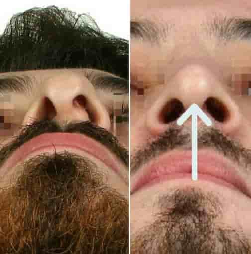 The Nose Aesthetic Clinic في Istanbul، Turkey تعليقات من مرضى حقيقيين
 Slider image 5