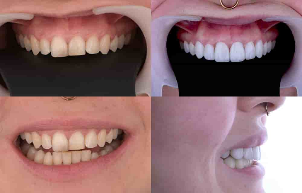 Dentleon Polyclinics في Izmir، Turkey تعليقات من مرضى حقيقيين
 Slider image 4