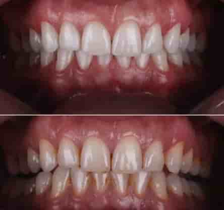Smile Zone Clinic في Ankara، Turkey تعليقات من مرضى حقيقيين
 Slider image 4
