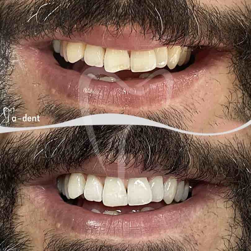A-dent Dental Clinic في Antalya، Turkey تعليقات من مرضى حقيقيين
 Slider image 2