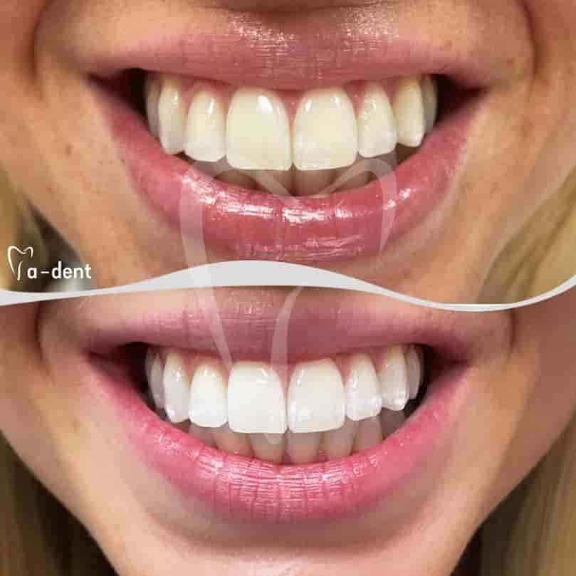 A-dent Dental Clinic في Antalya، Turkey تعليقات من مرضى حقيقيين
 Slider image 4