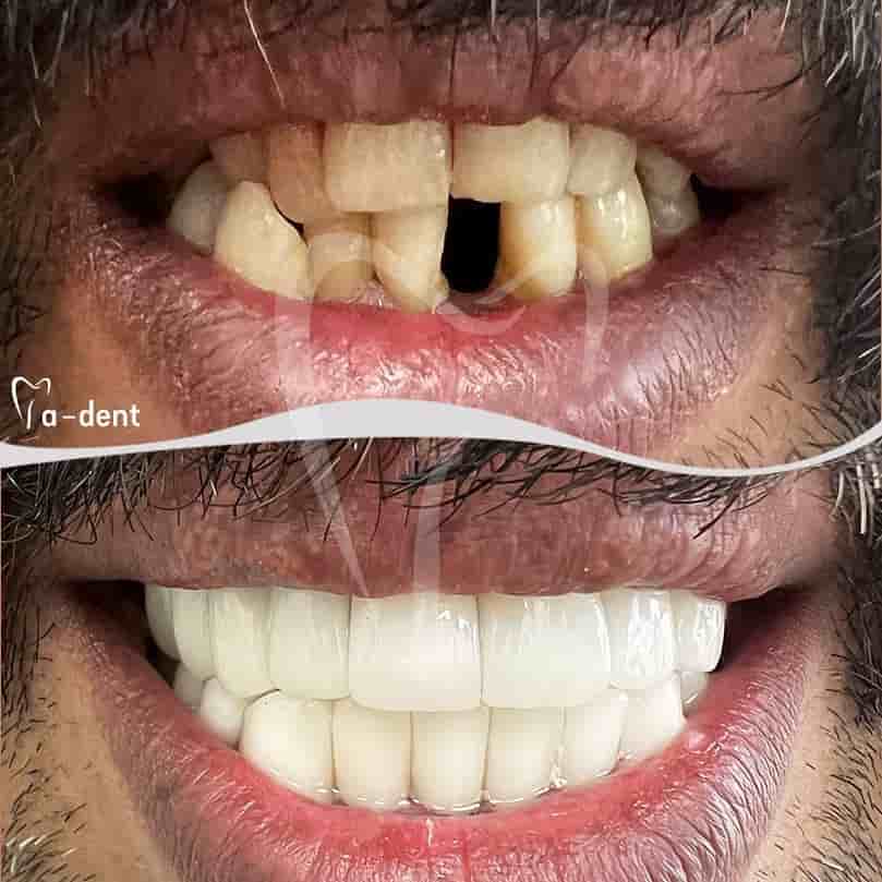 A-dent Dental Clinic في Antalya، Turkey تعليقات من مرضى حقيقيين
 Slider image 7