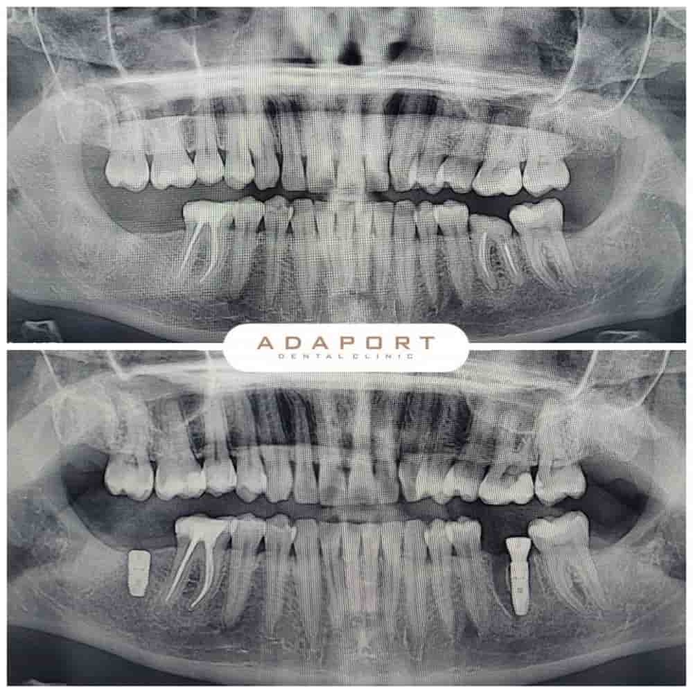 Adaport Dental Clinic في Izmir، Turkey تعليقات من مرضى حقيقيين
 Slider image 2