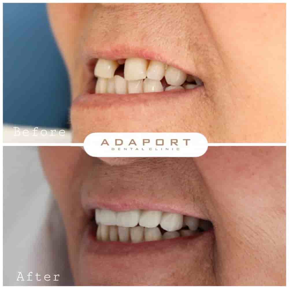 Adaport Dental Clinic في Izmir، Turkey تعليقات من مرضى حقيقيين
 Slider image 3