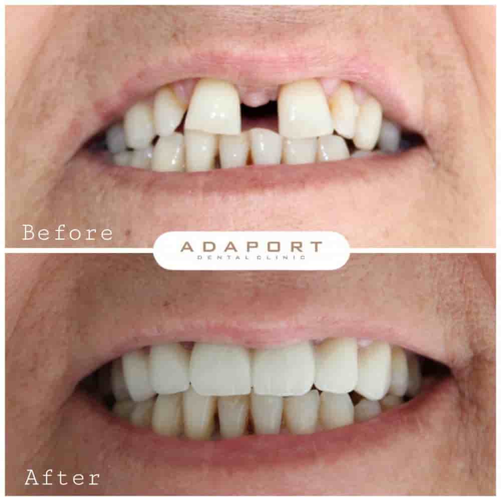 Adaport Dental Clinic في Izmir، Turkey تعليقات من مرضى حقيقيين
 Slider image 4