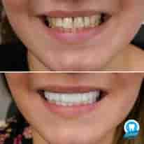 Turkiye Dental في ، Turkey تعليقات من مرضى حقيقيين
 Slider image 4