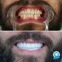 Turkiye Dental في ، Turkey تعليقات من مرضى حقيقيين
 Slider image 5