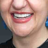 Turkiye Dental في ، Turkey تعليقات من مرضى حقيقيين
 Slider image 7