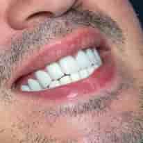 Turkiye Dental في ، Turkey تعليقات من مرضى حقيقيين
 Slider image 8