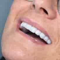 Turkiye Dental في ، Turkey تعليقات من مرضى حقيقيين
 Slider image 10