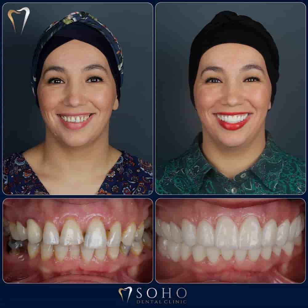 Soho Dental Clinic في Istanbul، Turkey تعليقات من مرضى حقيقيين
 Slider image 3
