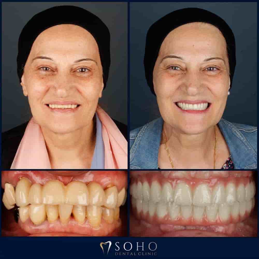 Soho Dental Clinic في Istanbul، Turkey تعليقات من مرضى حقيقيين
 Slider image 8