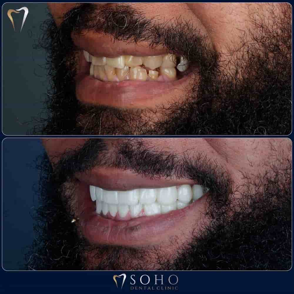 Soho Dental Clinic في Istanbul، Turkey تعليقات من مرضى حقيقيين
 Slider image 9