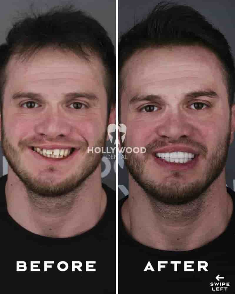 Hollywood Dental Izmir Turkey في Izmir، Turkey تعليقات من مرضى حقيقيين
 Slider image 1