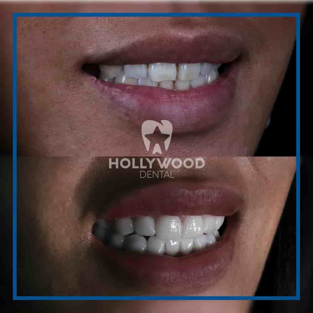 Hollywood Dental Izmir Turkey في Izmir، Turkey تعليقات من مرضى حقيقيين
 Slider image 5