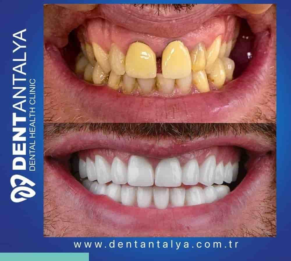 Dent Antalya في Antalya، Turkey تعليقات من مرضى حقيقيين
 Slider image 9