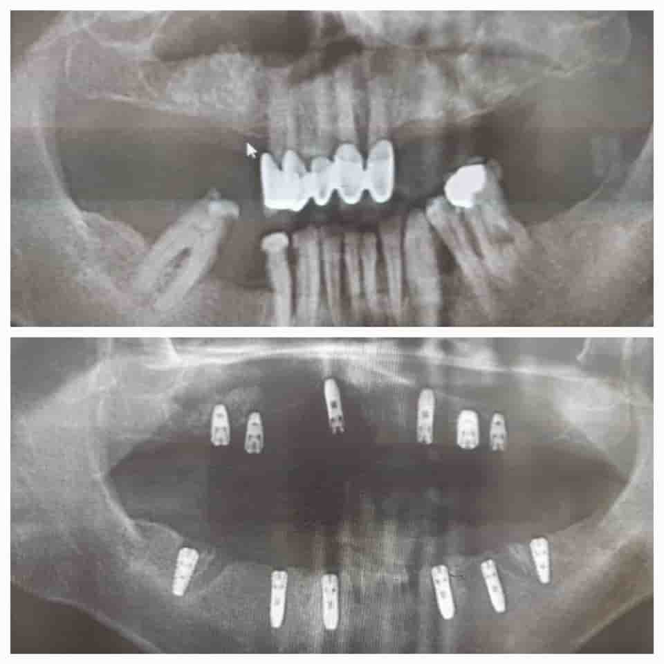Prestij Dental Clinic في Antalya، Turkey تعليقات من مرضى حقيقيين
 Slider image 8