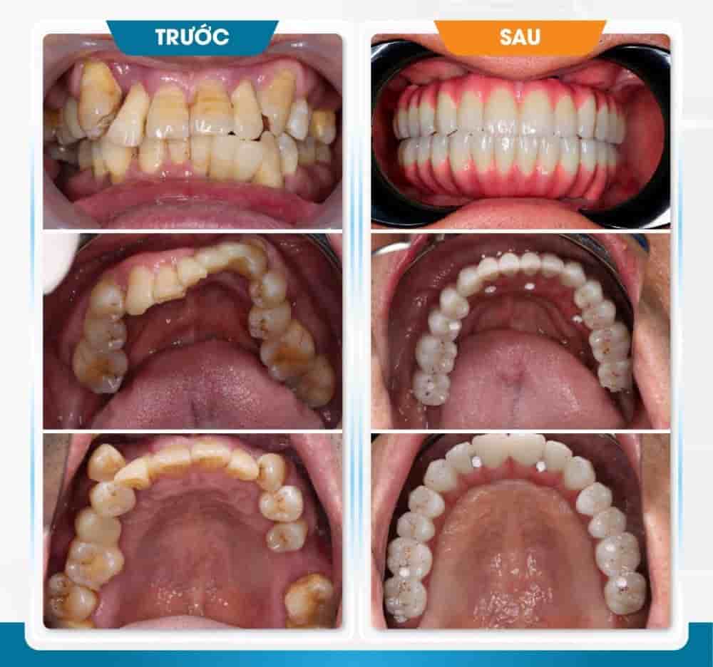 Dr. Care Implant Clinic في Ho Chi Minh، Vietnam تعليقات من مرضى حقيقيين
 Slider image 2