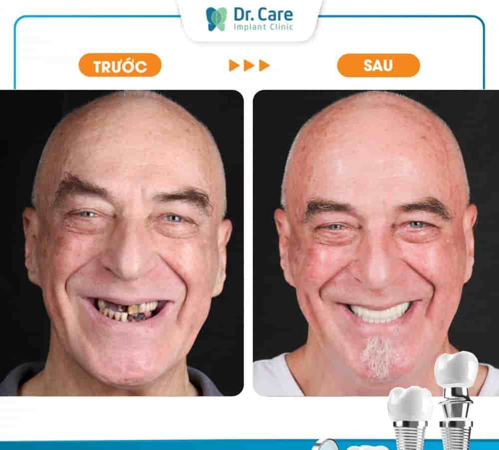Dr. Care Implant Clinic في Ho Chi Minh، Vietnam تعليقات من مرضى حقيقيين
 Slider image 3