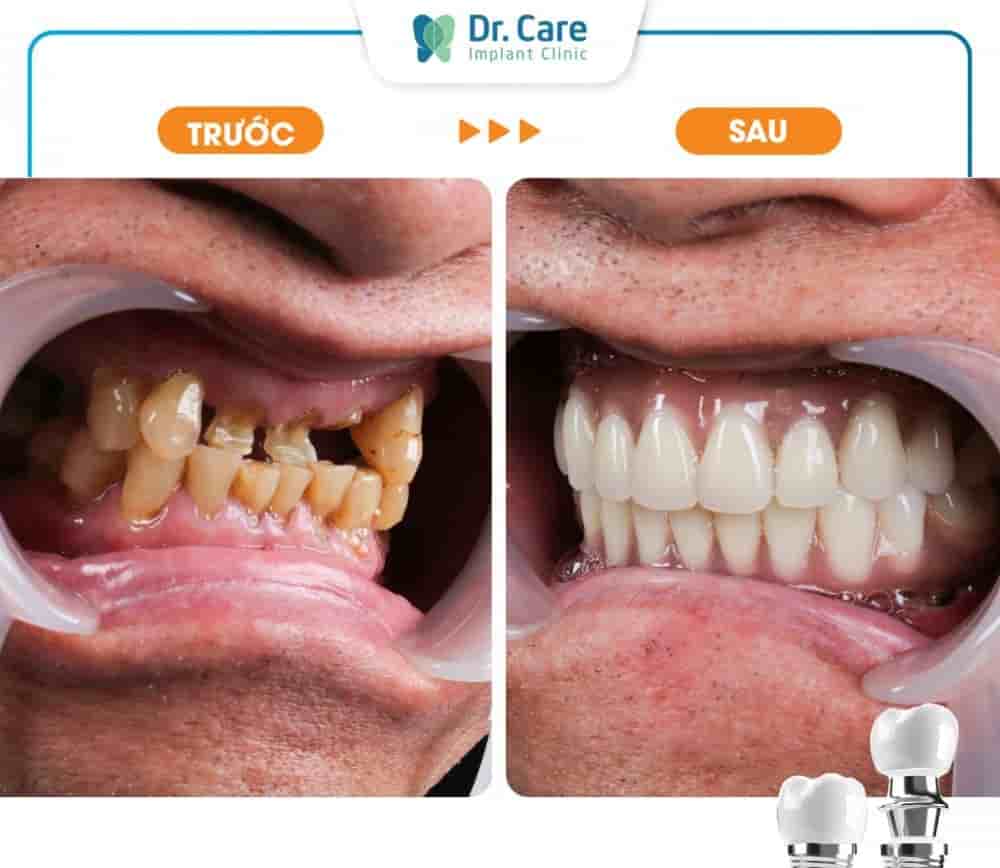 Dr. Care Implant Clinic في Ho Chi Minh، Vietnam تعليقات من مرضى حقيقيين
 Slider image 6