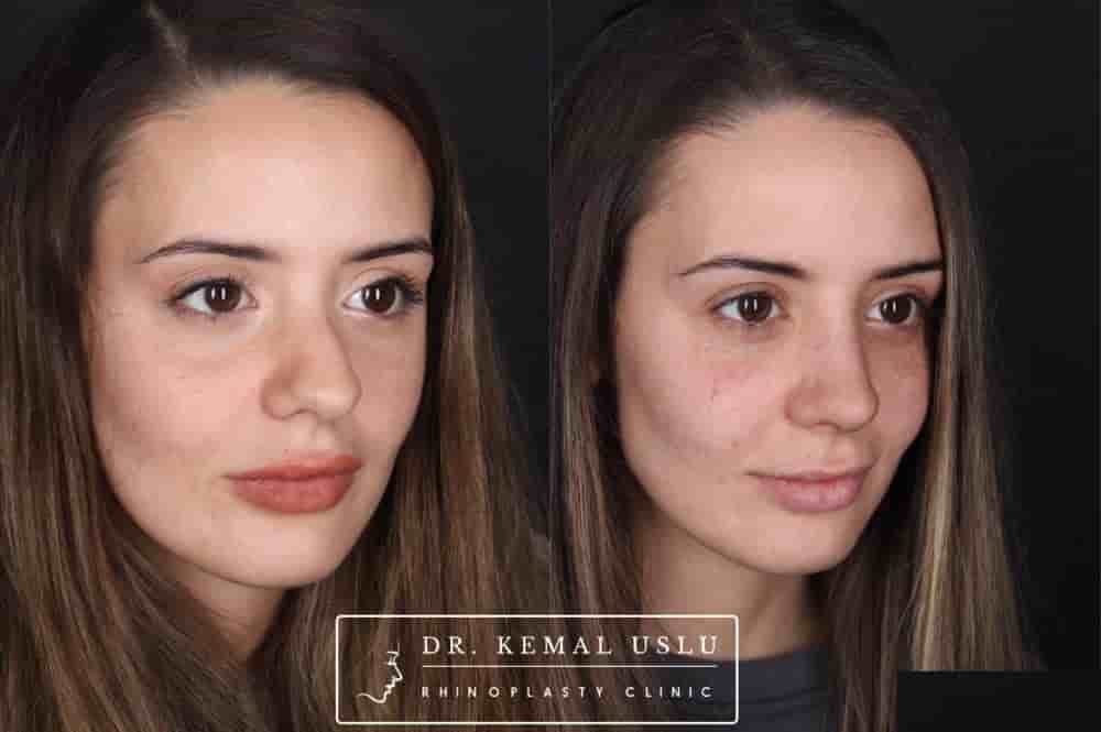 Dr. Kemal Uslu Clinic في Istanbul، Turkey تعليقات من مرضى حقيقيين
 Slider image 6