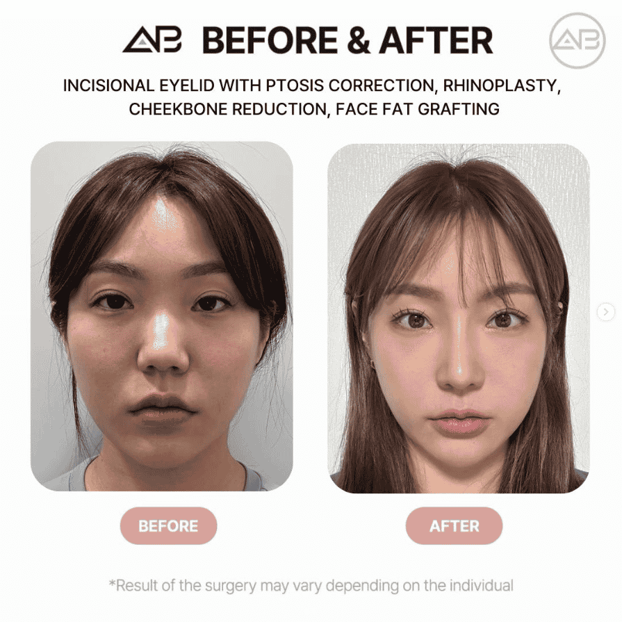 AB Plastic Surgery in Seoul, South Korea Reviews from Real Patients Slider image 4