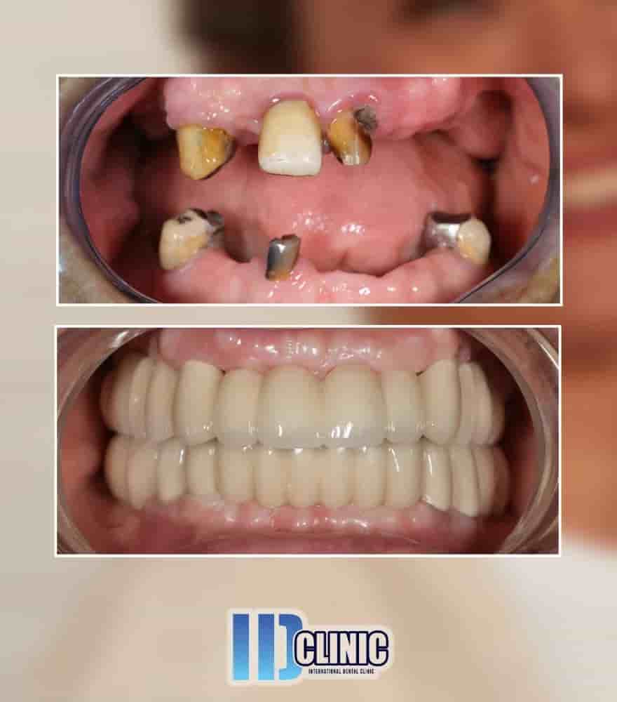 IDC International Dental Clinic في Antalya، Turkey تعليقات من مرضى حقيقيين
 Slider image 2
