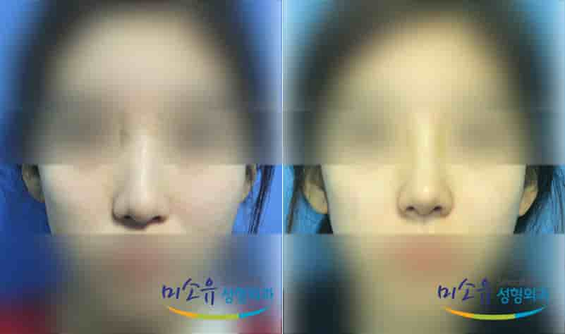 MISOU Plastic Surgery في Seoul، South Korea تعليقات من مرضى حقيقيين
 Slider image 3