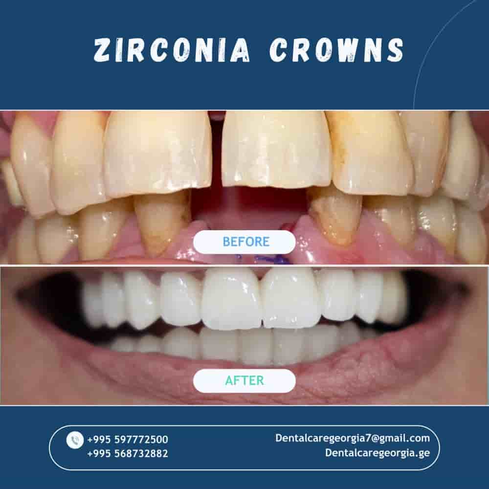 Universe Dental - Best Dental Clinic in Tbilisi, Georgia في Tbilisi، Georgia تعليقات من مرضى حقيقيين
 Slider image 5