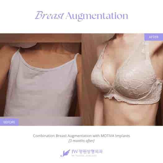 JW Plastic Surgery Korea في Seoul، South Korea تعليقات من مرضى حقيقيين
 Slider image 4