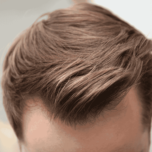 زراعة الشعر بتقنية FUE في عيادة بيلوس - استرجع شعرك مع عيادة بيلوس