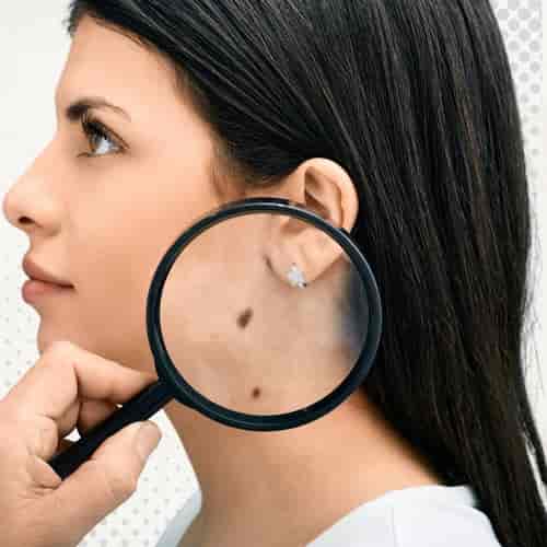 حزمة علاج سرطان الجلد باستخدام الخلايا اللمفاوية المتسللة للورم في الصين من مجموعة بكين بيوكوس الطبية