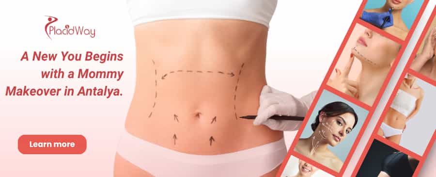 عملية تجميل الأم في أنطاليا، تركيا thumbnail