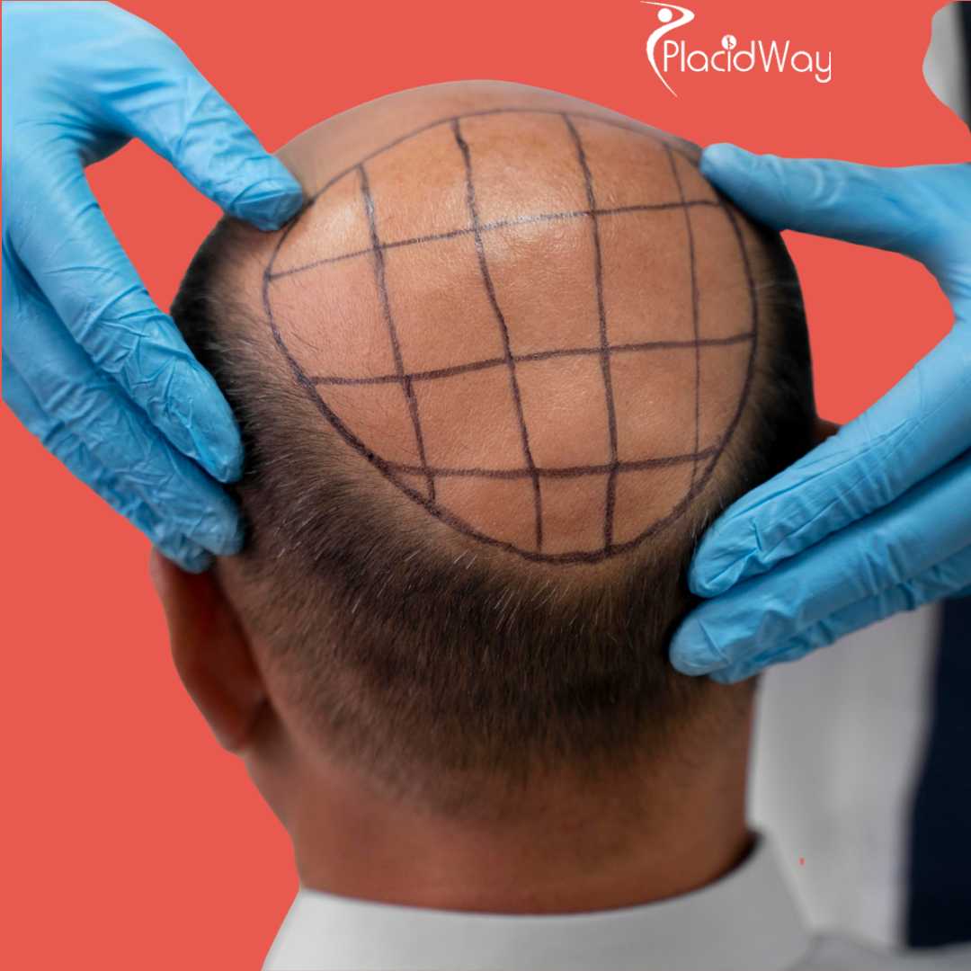 زراعة الشعر في تركيا
