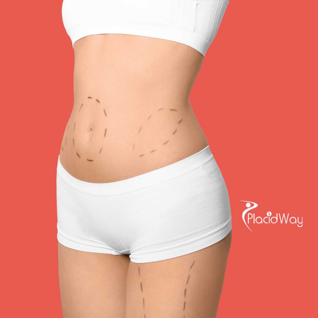 شد البطن في تايلاند