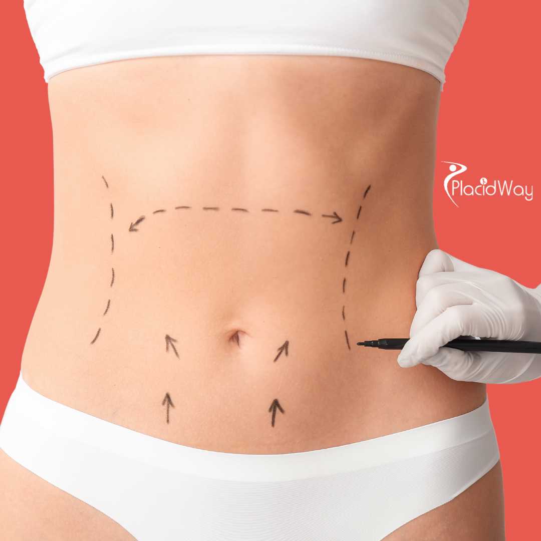 عملية تجميل الأم في أنطاليا، تركيا