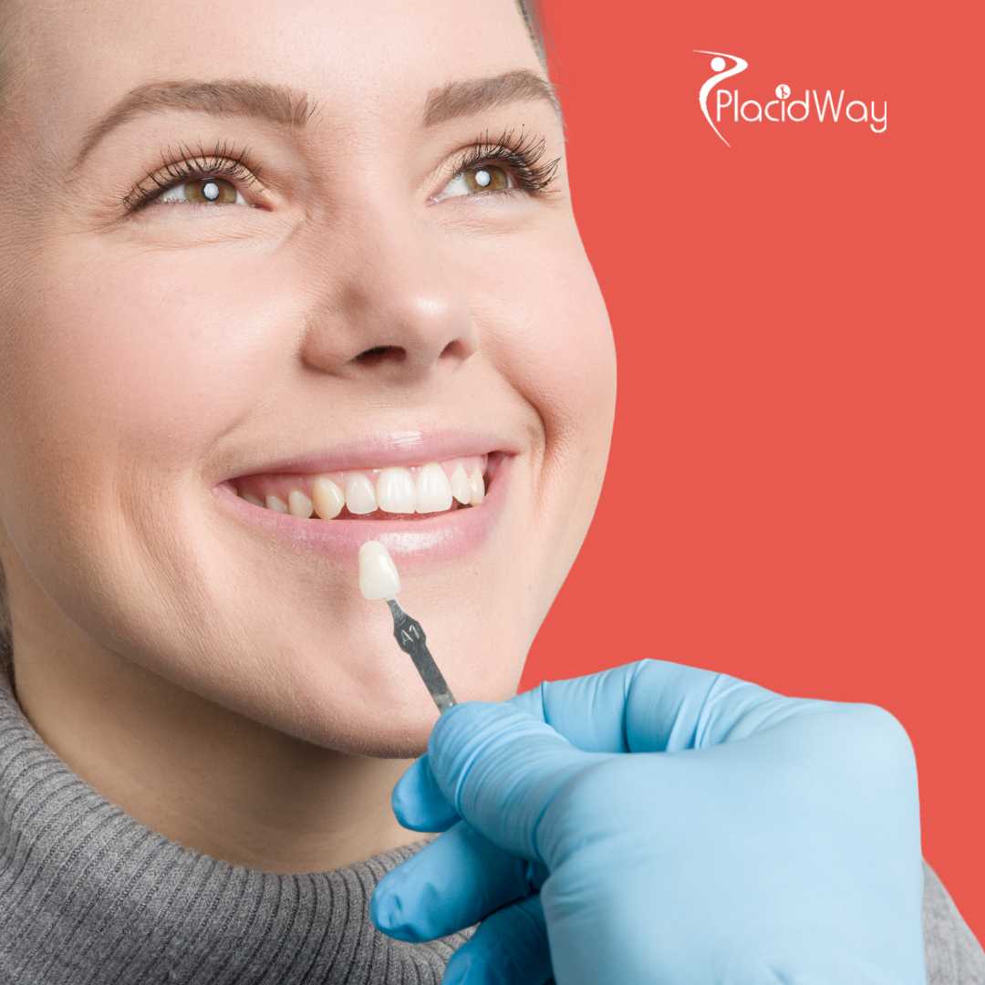 قشور الأسنان في إزمير، تركيا