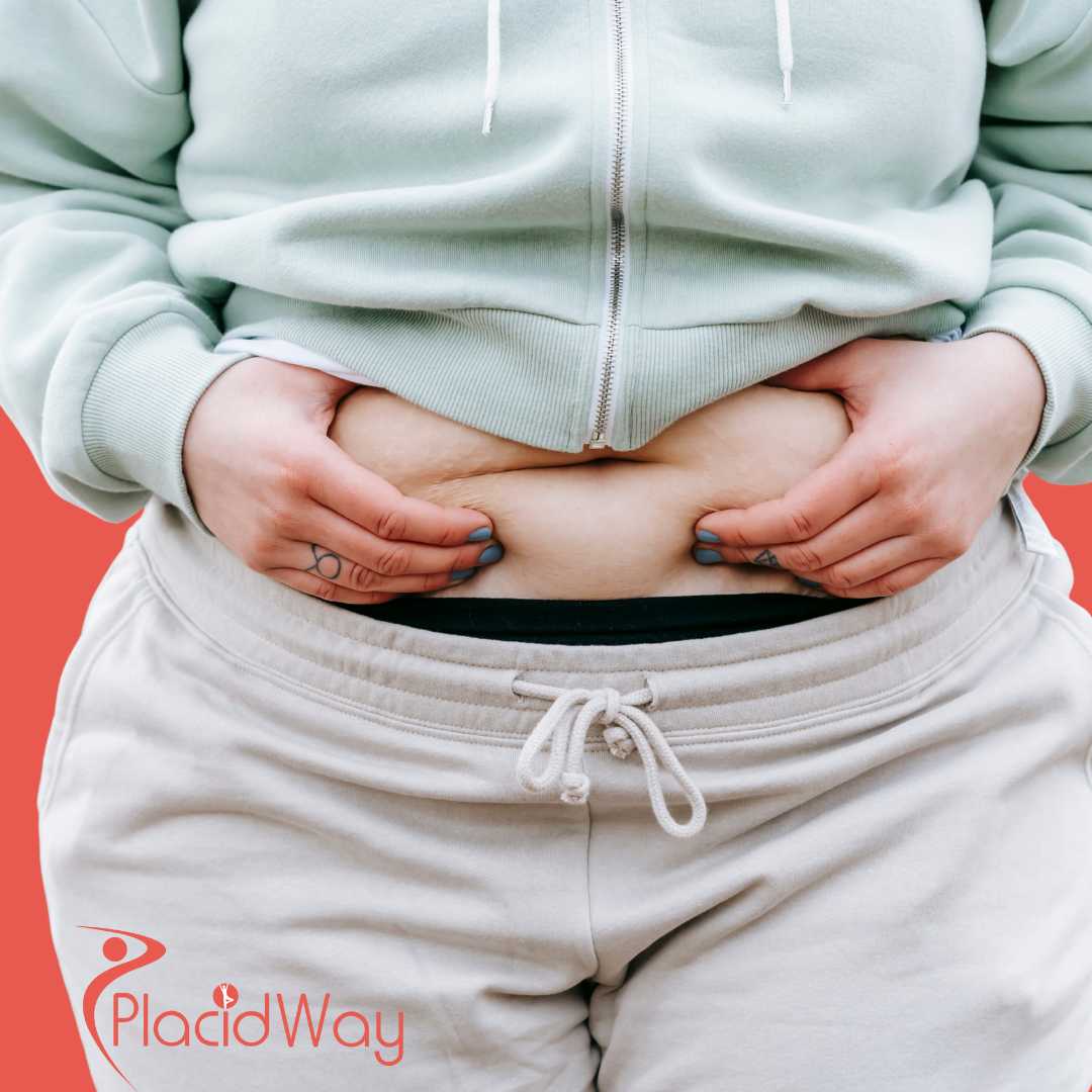 شد البطن في أنقرة، تركيا