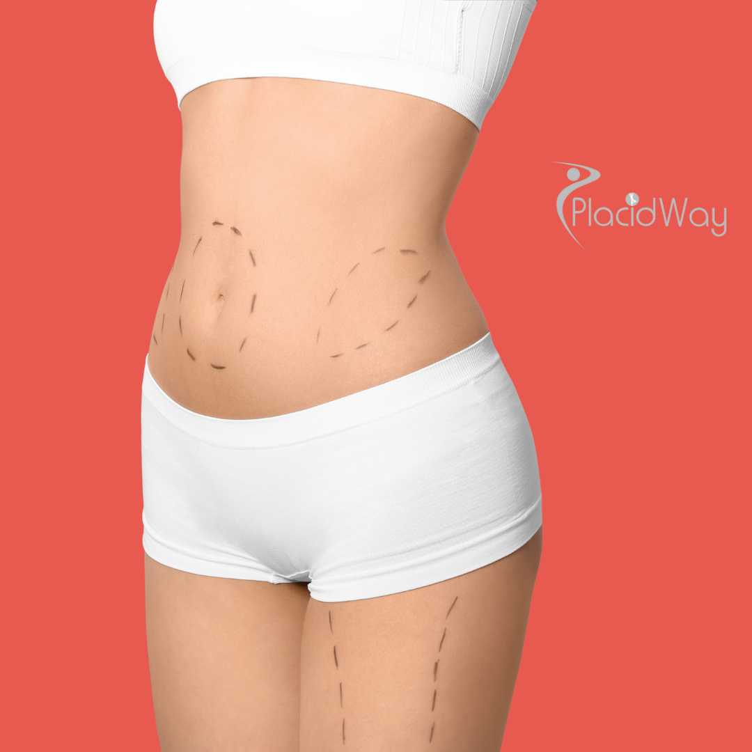 عملية تجميل الأم في إزمير، تركيا