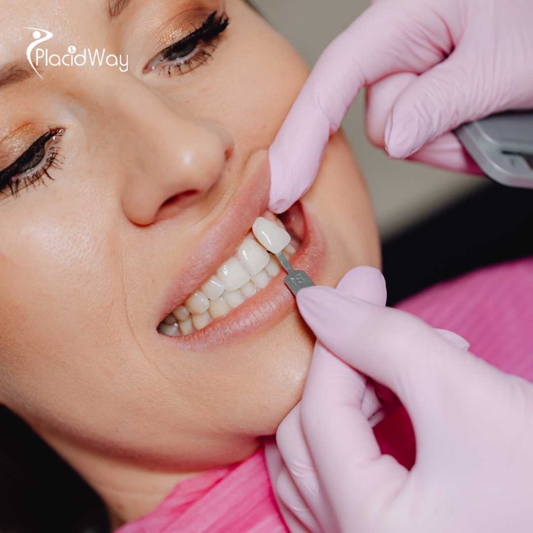 قشور الأسنان في اسطنبول