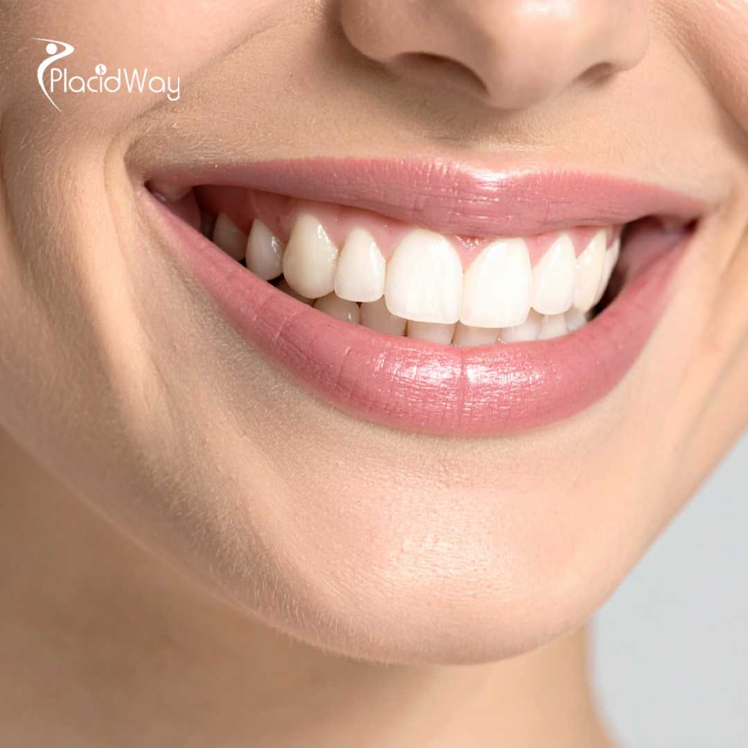 زراعة الأسنان All on 8 في تايلاند - احصل على زراعة الأسنان في الخارج 