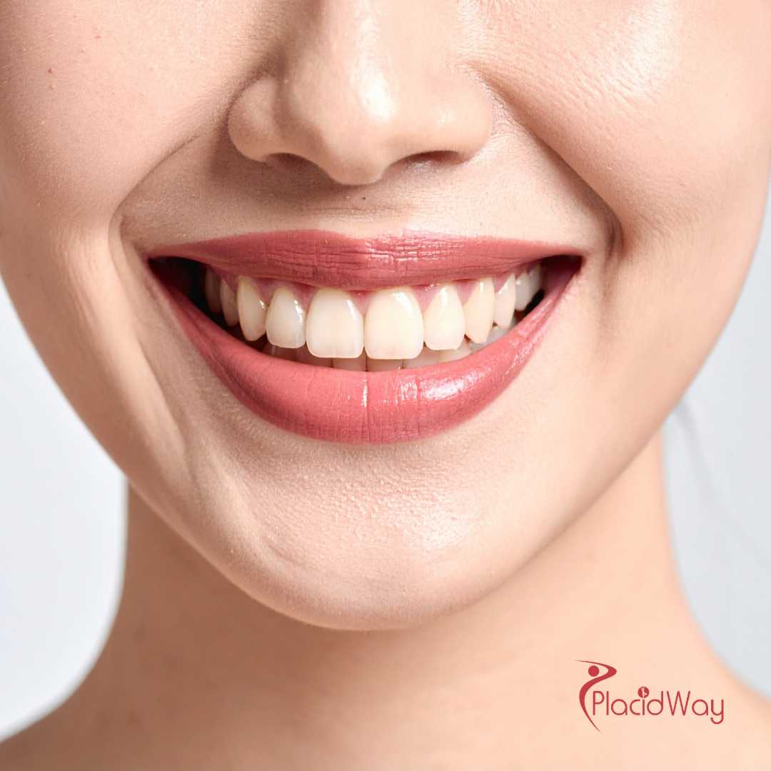 زراعة الأسنان All on 6 في تركيا